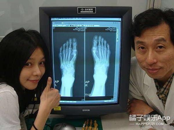 贝嫂拇指外翻手术_女明星的脚趾头最美_容祖儿拇指外翻