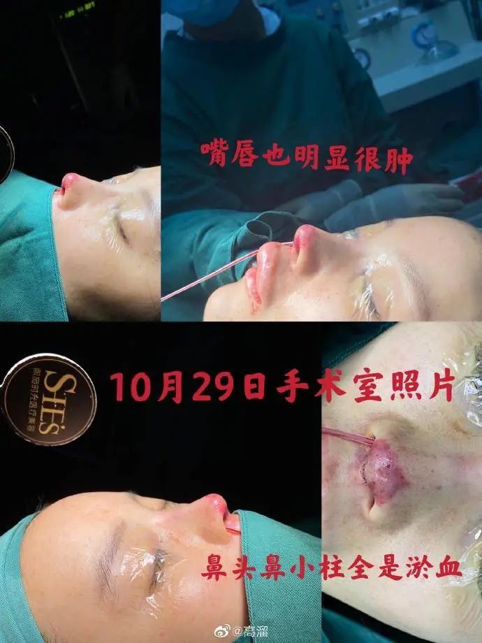 医美事故受害者高溜_整容失败的女明星中国_演员高溜整容失败鼻头坏死维权
